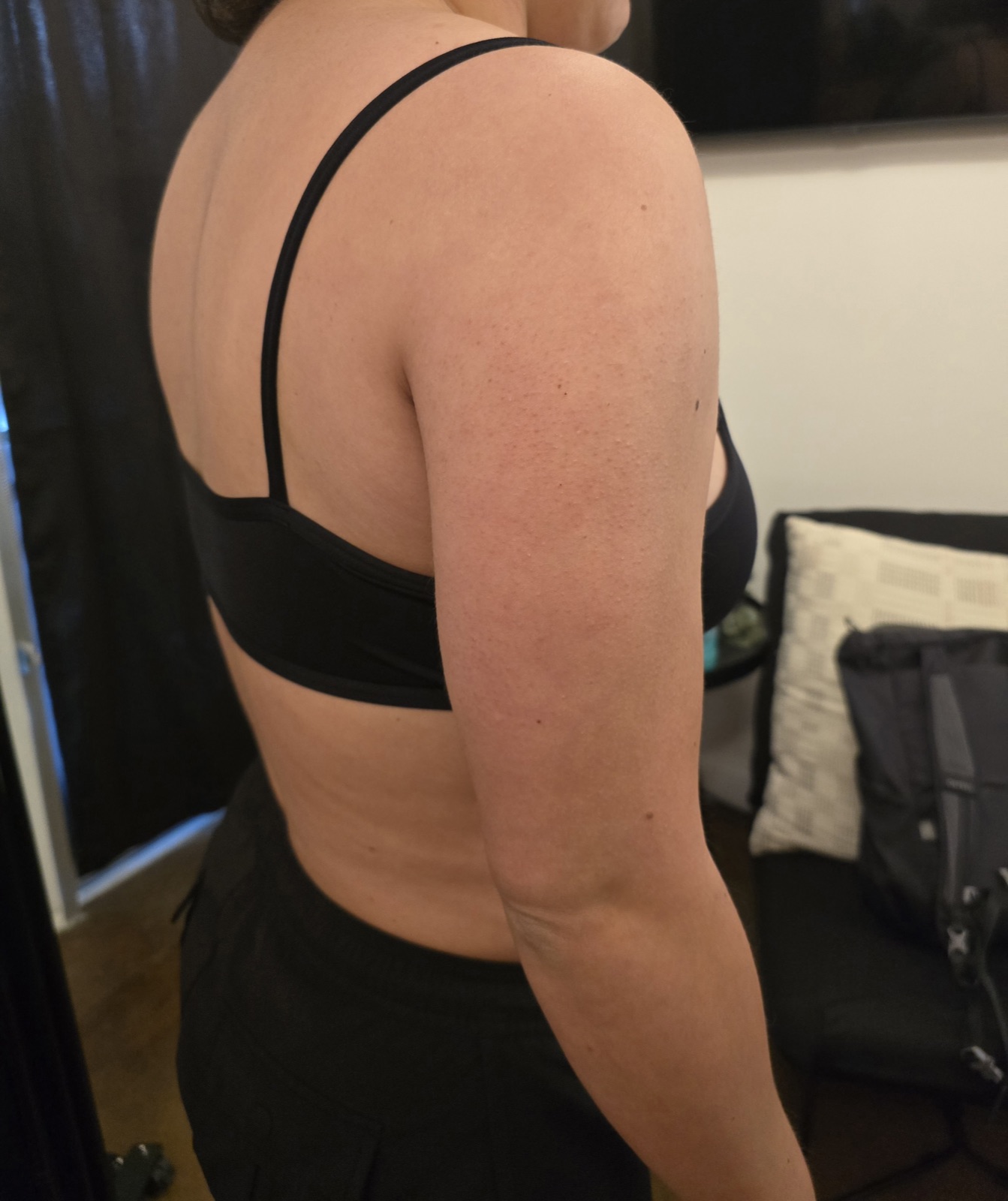 Arm Sculpting after treatment