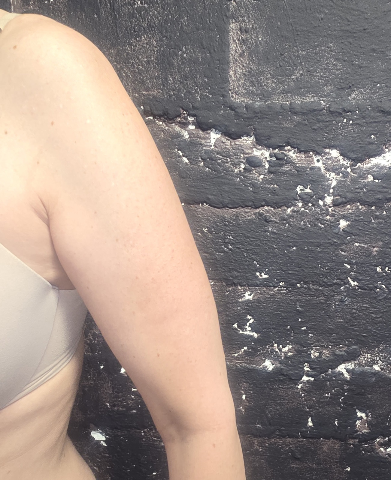 Cellulite Reduction after treatment