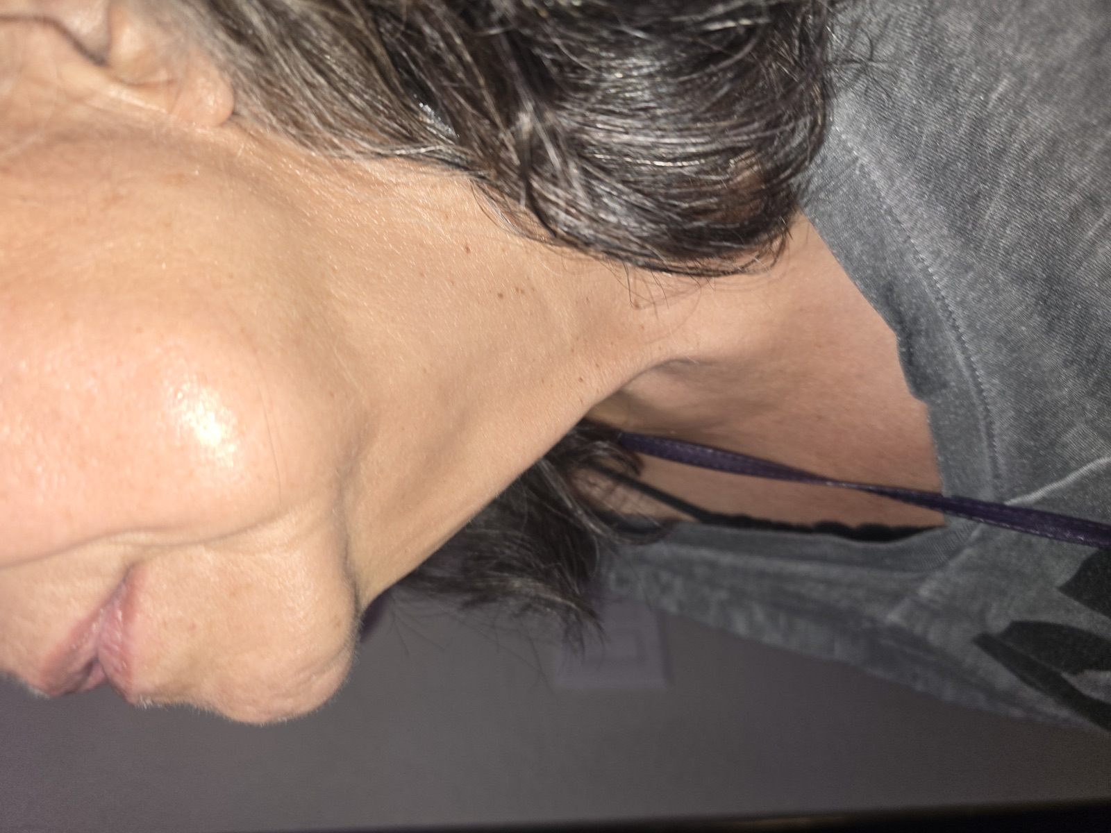 Chin & Neck after treatment