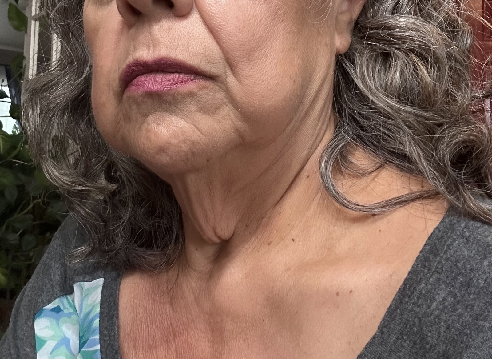 Chin & Neck before treatment